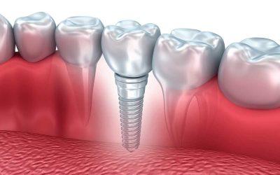 ¿Qué son los implantes dentales?