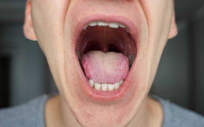 Cáncer oral: señales de alerta para su detección precoz