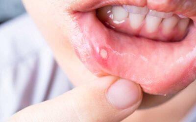 Llagas o aftas orales: por qué aparecen con frecuencia