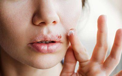 Herpes simple: primera infección y síntomas principales