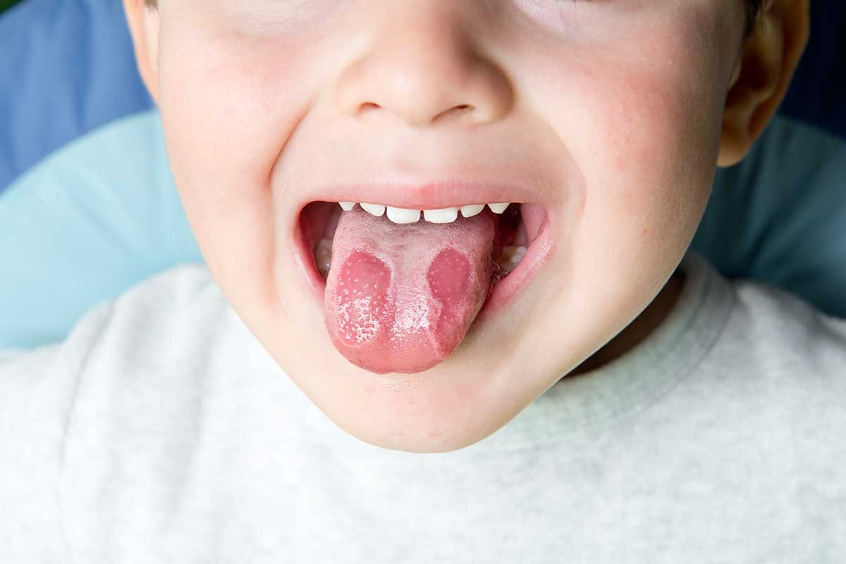 b2ap3_large_lengua-geografica-clinica-dental-barcelona