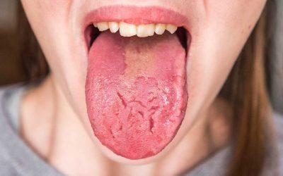 ¿Cómo se manifiesta la anemia en la boca?