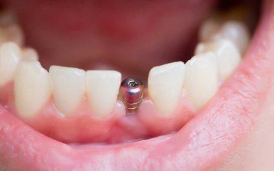 ¿Por qué se produce el «rechazo» de un implante dental?