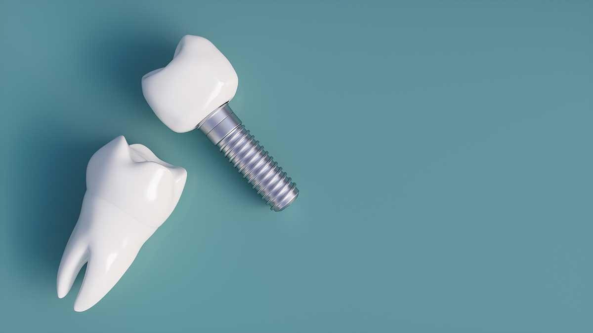 b2ap3_large_implantes-dentales-alternativas-injerto-hueso