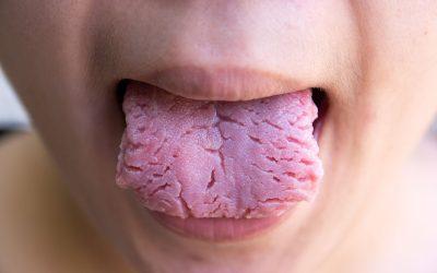 ¿Qué es la lengua fisurada?