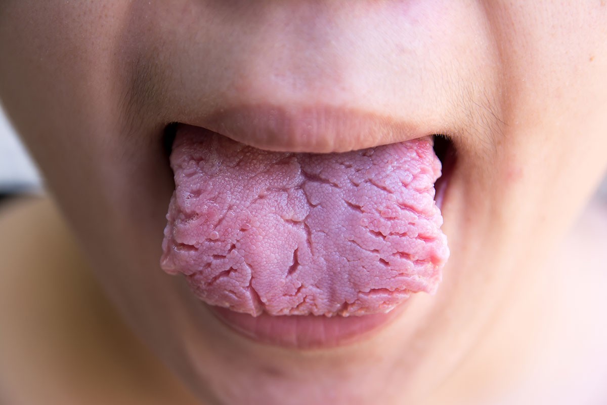 b2ap3_large_lengua-geografica-escrotal-tratamiento