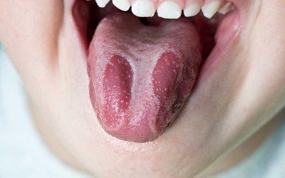 ¿Qué es la lengua geográfica o glositis migratoria benigna?