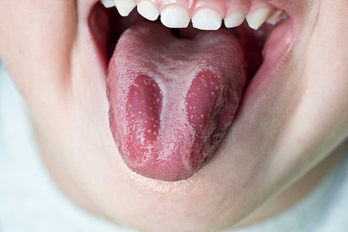 b2ap3_large_lengua-geografica-glositis-migratoria-benigna