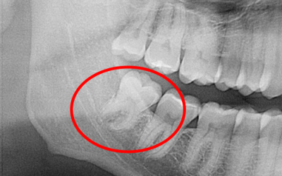 ¿Cúales son las preguntas más frecuentes sobre el daño de los nervios de la mandíbula y la lengua tras la extracción de las muelas del juicio?