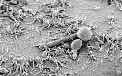 Infecciones por hongos en la cavidad oral: la candidiasis oral