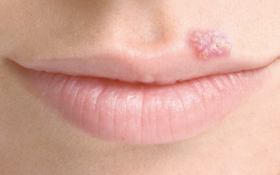 Terapia fotodinámica para el tratamiento de herpes labial