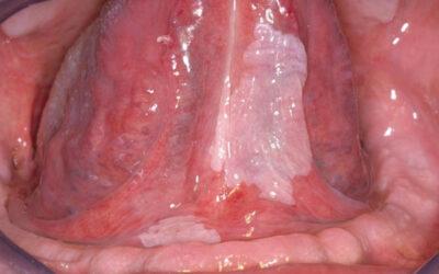 La Leucoplasia Oral